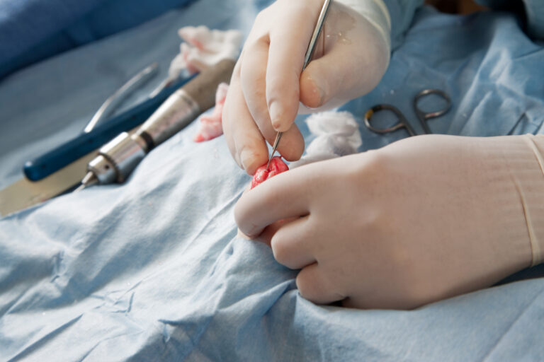 Operationsmetoden viktig för resultatet vid korsbandskirurgi